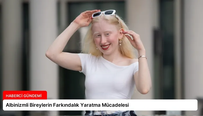 Albinizmli Bireylerin Farkındalık Yaratma Mücadelesi